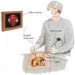 laparoscopy_surgeon